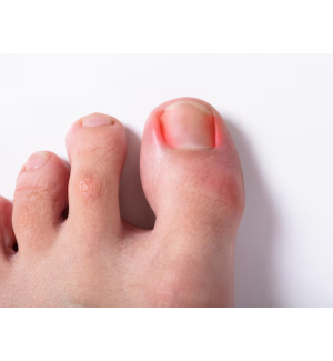 Eingewachsener Zehennagel